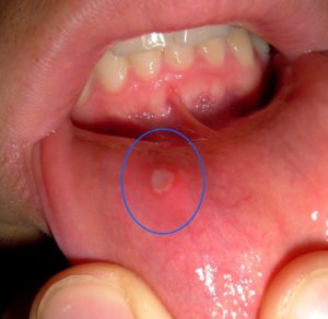 what causes white sores in your mouth